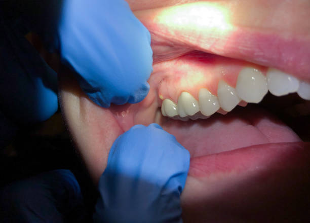 Best Emergency Care for Gum Disease in Boston, MA
